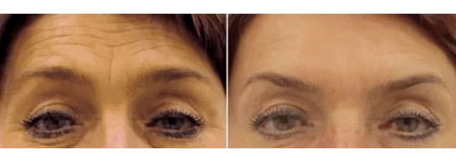 أجهزة للتجديد الجزئي