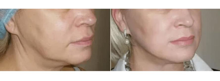 الانتعاش بعد تجديد الجلد